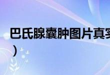 巴氏腺囊肿图片真实造口术（巴氏腺囊肿图片）