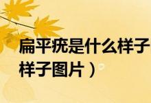 扁平疣是什么样子图片 特征（扁平疣是什么样子图片）