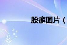 股癣图片（股癣图片大全）